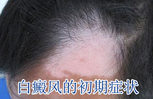 ����ĺ�ת֢״��ʲô