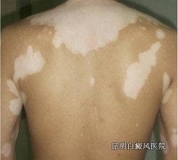 ���˰��综�ߵĳ�����֢״