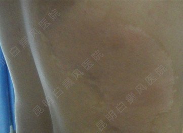 男性背部局限型白癜风5年