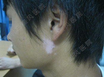 男性耳部局限型白癜风2年