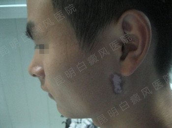 男性耳部局限型白癜风2年