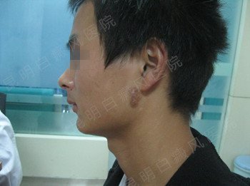 男性耳部局限型白癜风2年
