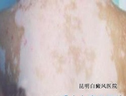 �ڶ��Ͱ����֢״����Щ