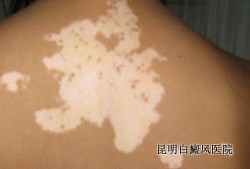 �����ϰ��粻ͬ��֢״