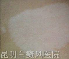白癜风的主要症状