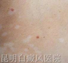 白癜风早期症状图片