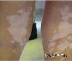 白癜风典型症状是什么呢 白癜风典型症状是什么呢