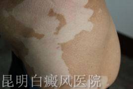 白癜风扩散时期有哪些表现 白癜风扩散时期有哪些表现