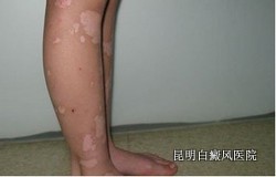 ����һ��ʼ��֢״��ʲô