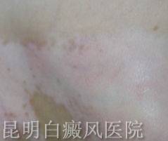 白癜风早期的发病症状有什么 白癜风早期的发病症状有什么