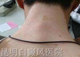 白癜风扩散后有什么症状 白癜风扩散后有什么症状