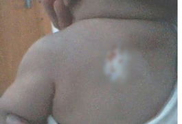 儿童白癜风的危害有哪些 儿童白癜风的危害有哪些