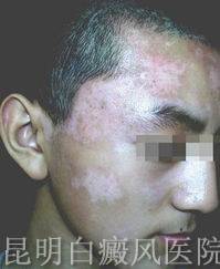 脸上白癜风是什么样的症状 脸上白癜风是什么样的症状