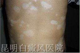 散发型白癜风有哪些症状 散发型白癜风有哪些症状