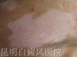白癜风的主要症状都有什么 白癜风的主要症状都有什么