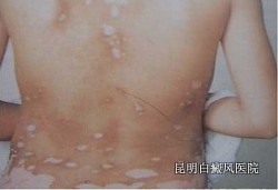 白癜风早期症状图片是什么 白癜风早期症状图片是什么