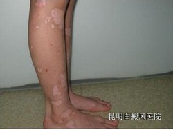 白癜风的早期症状是什么呢 白癜风的早期症状是什么呢