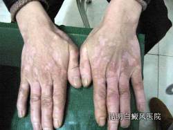 �������ʱ����Щ֢״