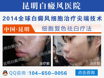 长期心理压力会诱发白癜风吗?